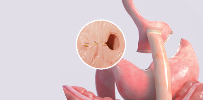 Obesidad - Mujeres sonriendo