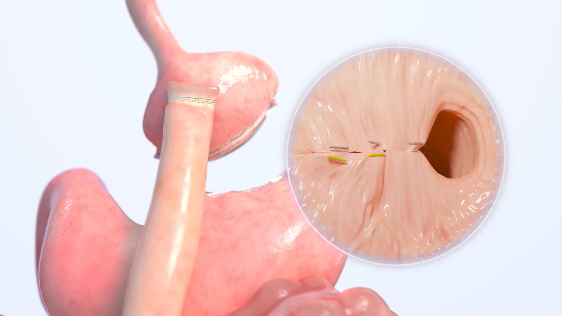 Gastroplastia endoscópica en manga (ESG)