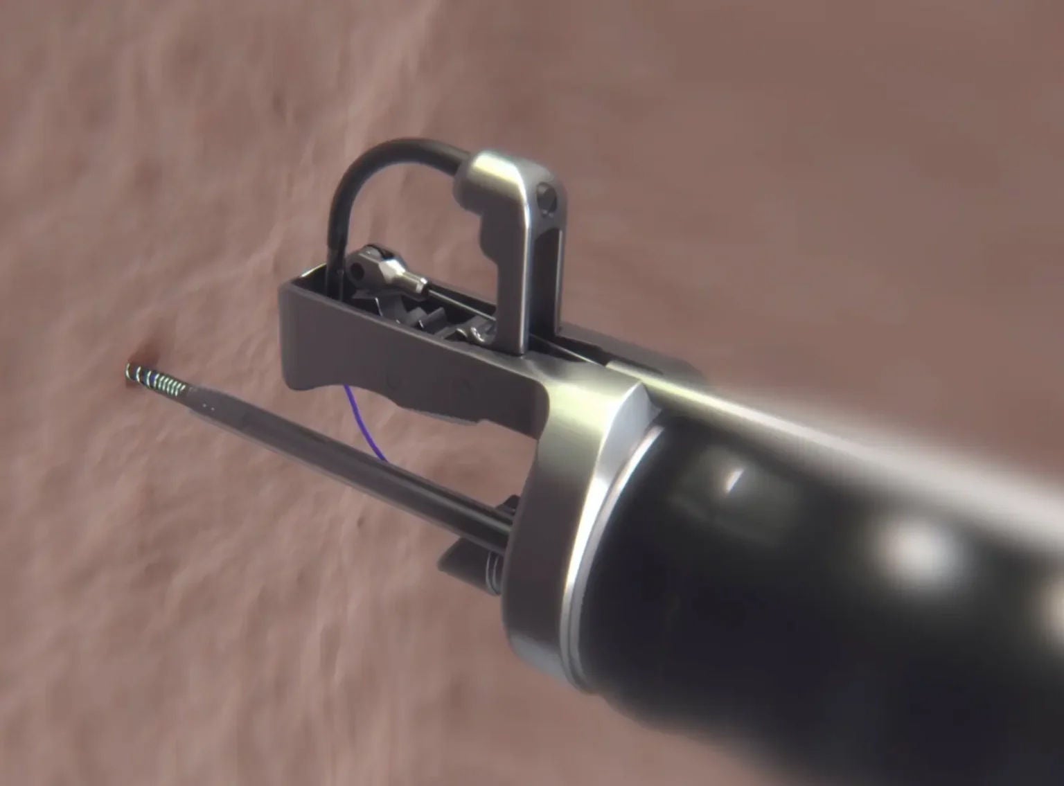 Gastroplastia endoscópica en manga (ESG)